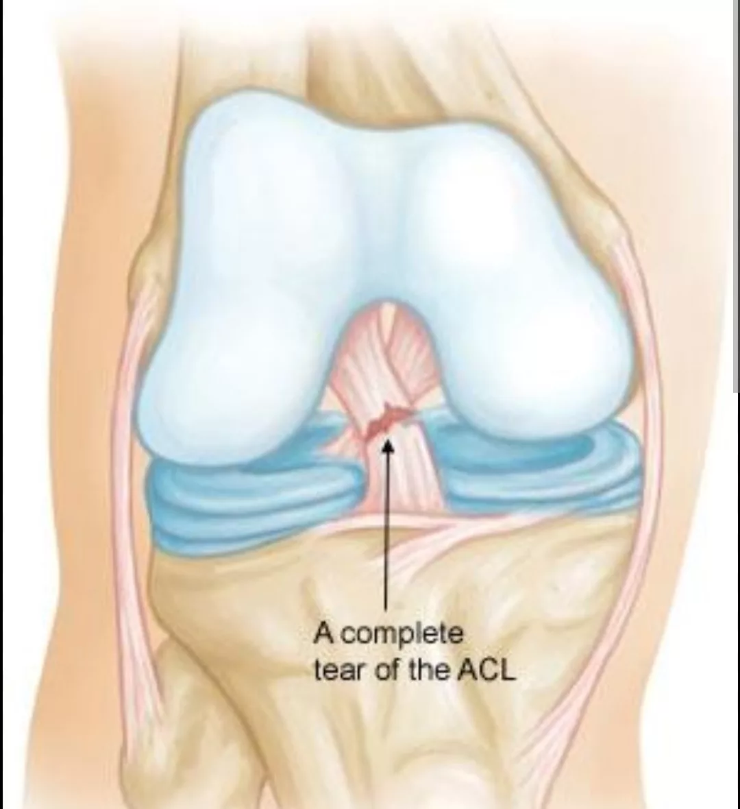 Cruciate Ligament Injury! Athletes Nightmare, Meaning, Ways To Manage And Avoid It