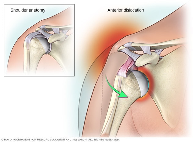 Shoulder dislocation
